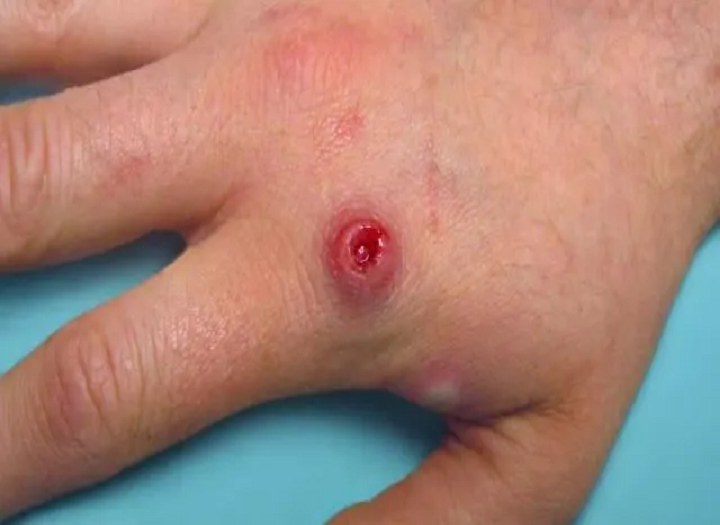 Monkeypox verstehen und wie man es verhindern？